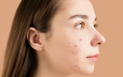 Trattamento dell’Acne Persistente: La Soluzione dello Studio Cuna