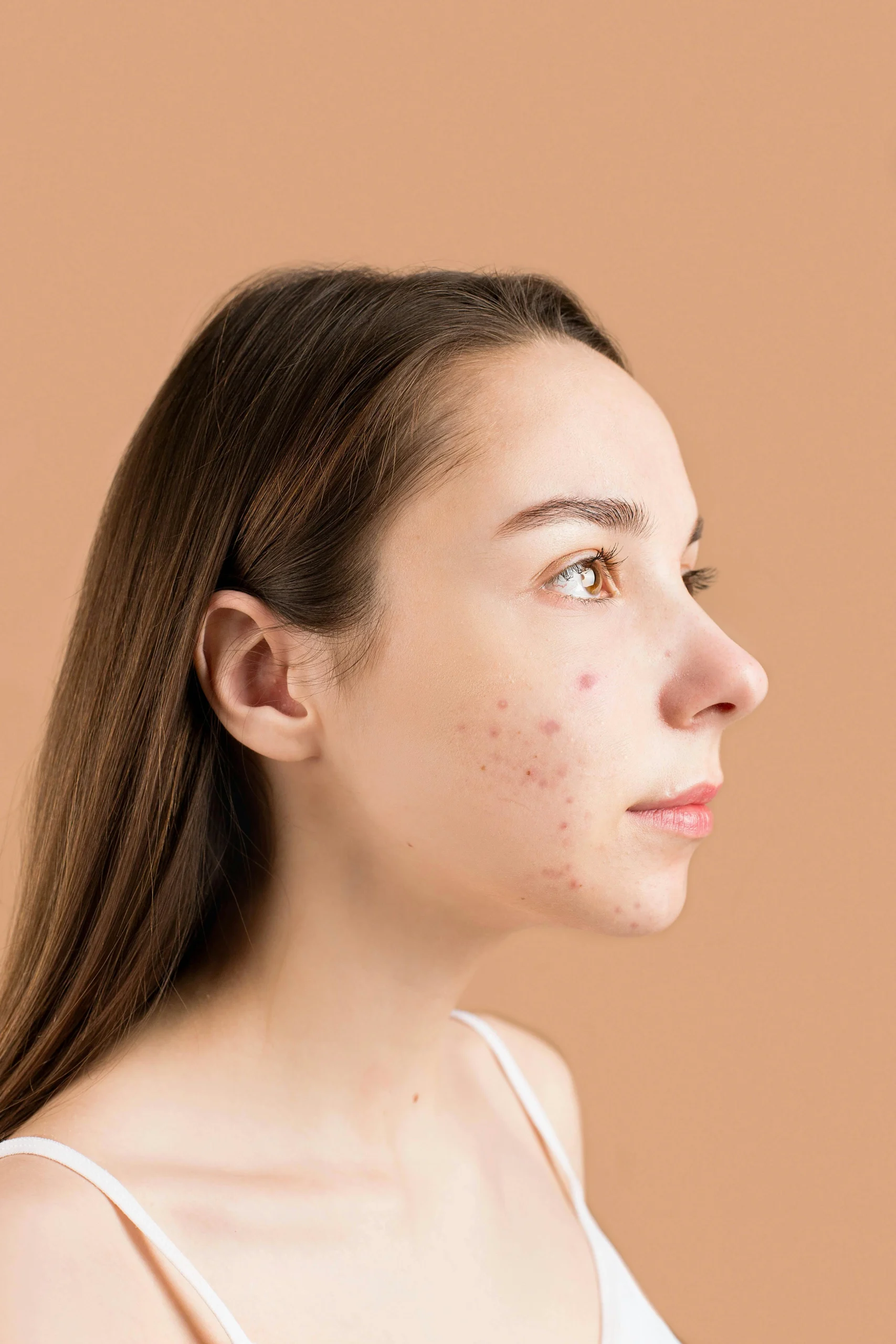 Acne Dott. Cuna